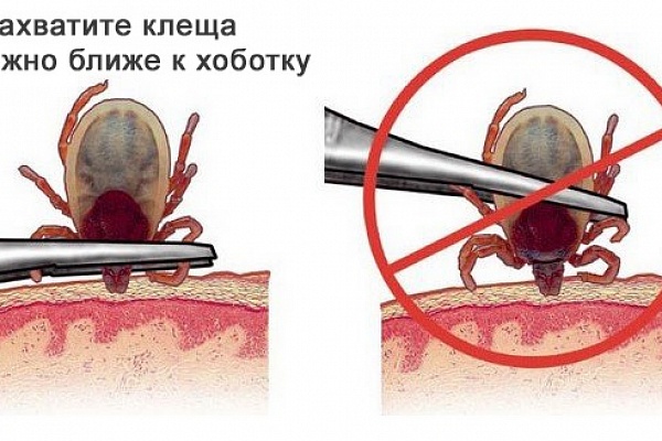 Алгоритм действий при укусе клеща!